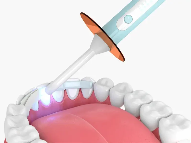Tooth Bonding
