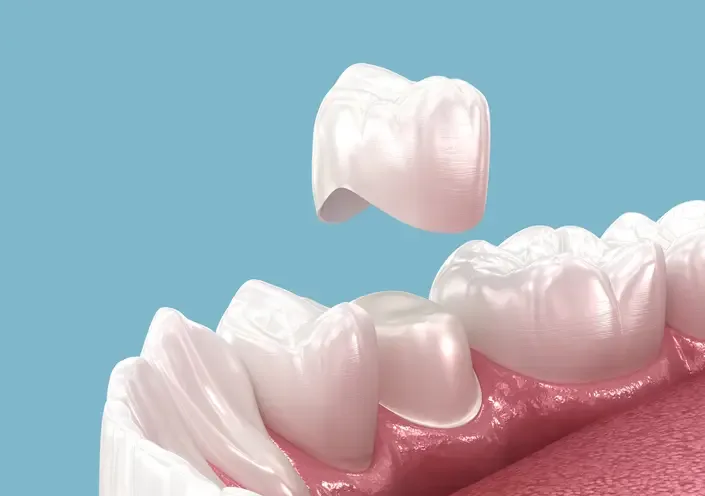 Dental crown illustration