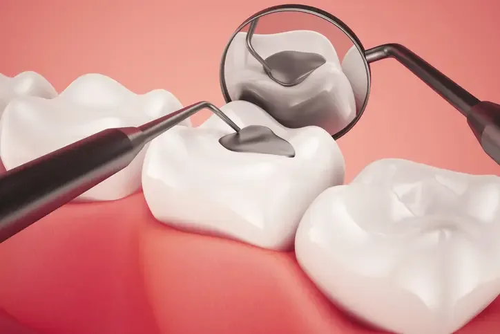 Dental filling closeup