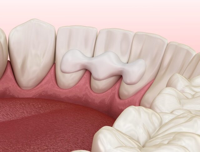 Dental bonding illustration closeup