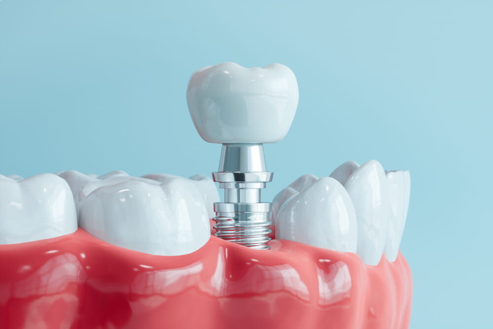 Dental implant 3D illustration