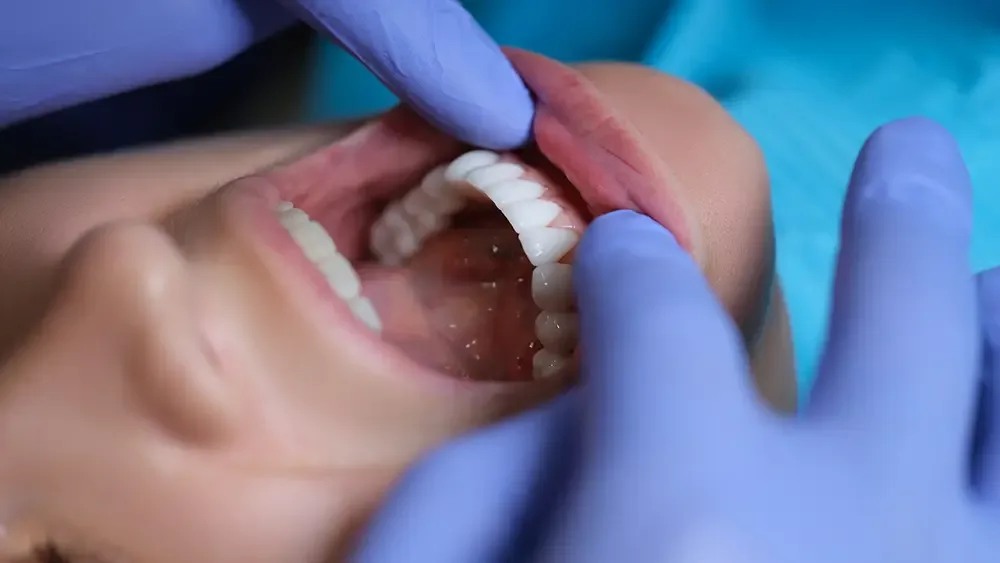 Porcelain veneers exam closeup
