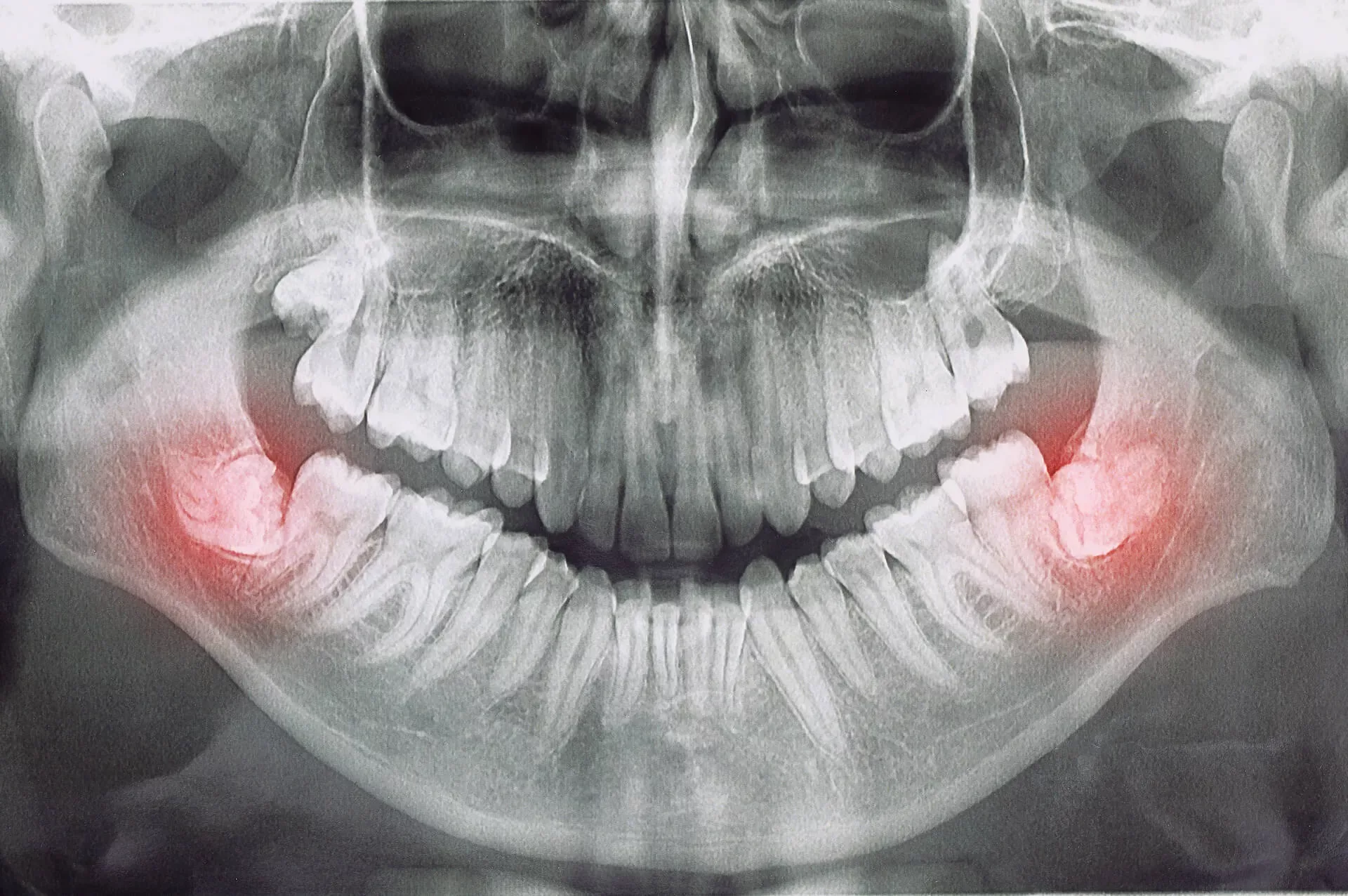 Wisdom Teeth Removal